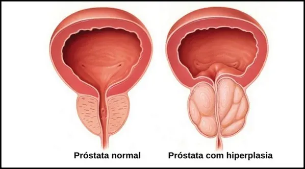 Câncer de Próstata