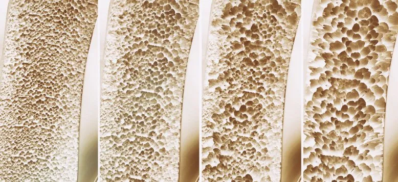 Osteoporose