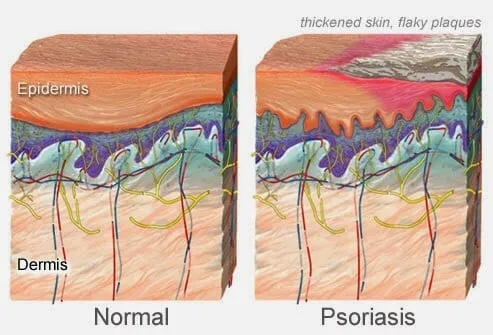 psoriase psoriase