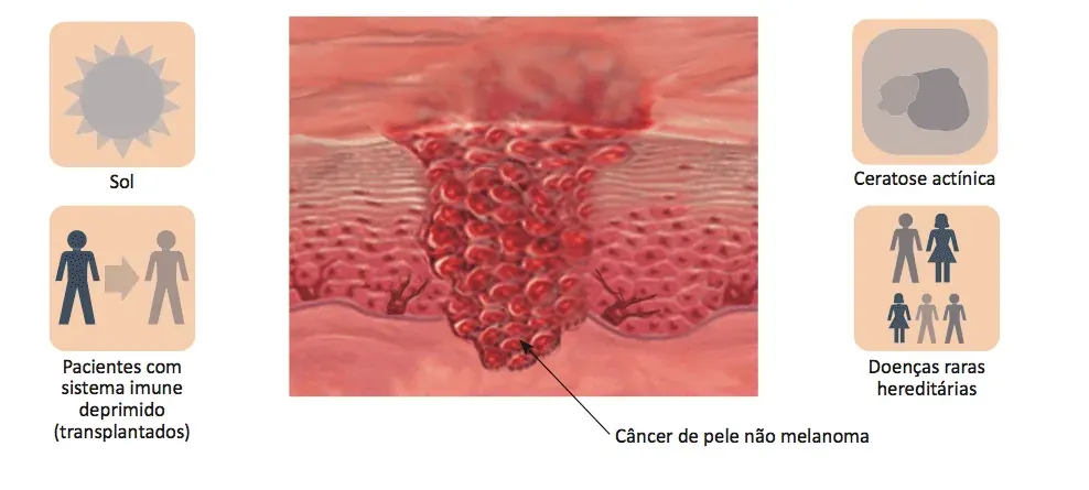 cancêr de pele não melanoma (1) cancêr de pele não melanoma (1)
