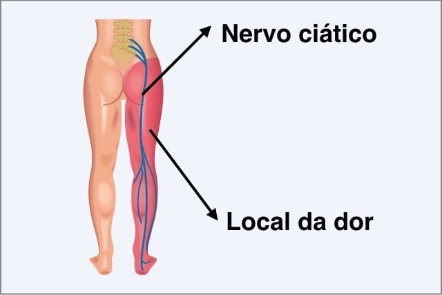 Nervo Ciático