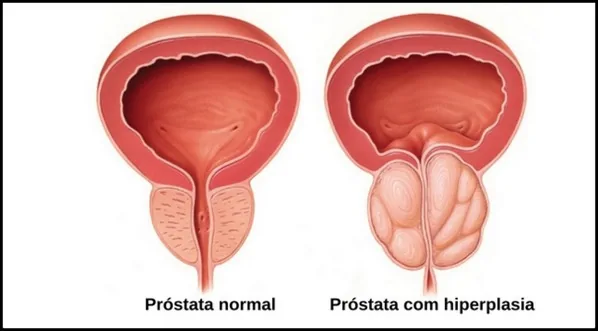 Câncer de Próstata