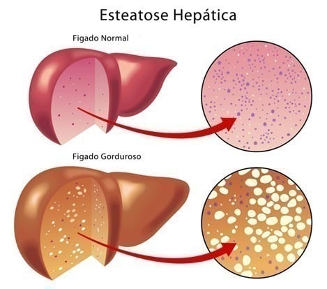 ESTEATOSE OU DOENÇAS HEPÁTICAS GORDUROSAS
