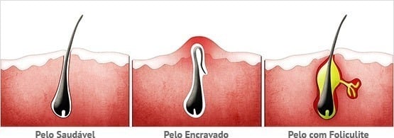 o-que-e-foliculite o-que-e-foliculite