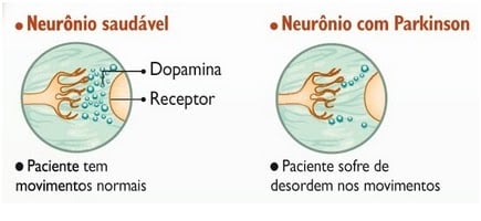 Doença de Parkinson