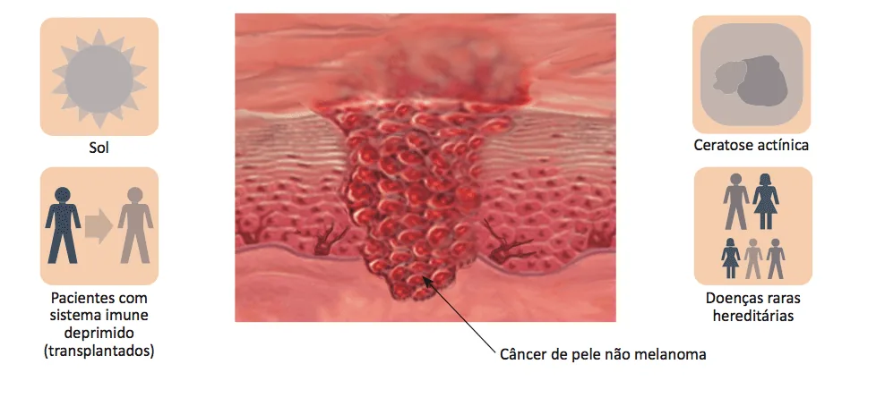 cancêr de pele não melanoma (1) cancêr de pele não melanoma (1)