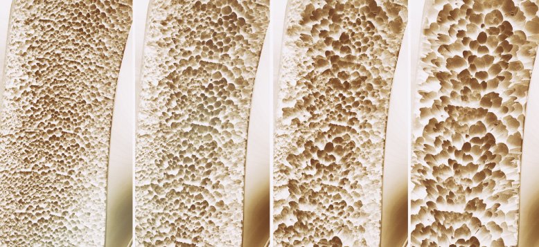 Osteoporose