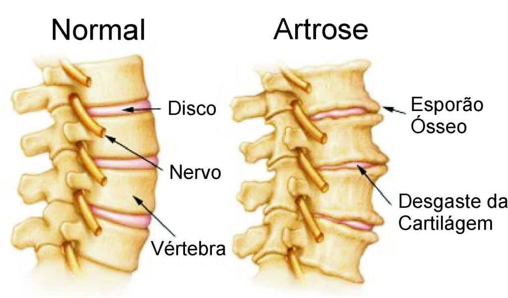 Artrose