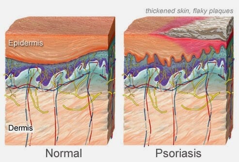 psoriase psoriase